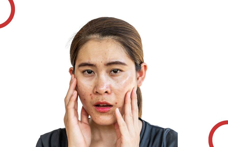 Say goodbye to acne scars