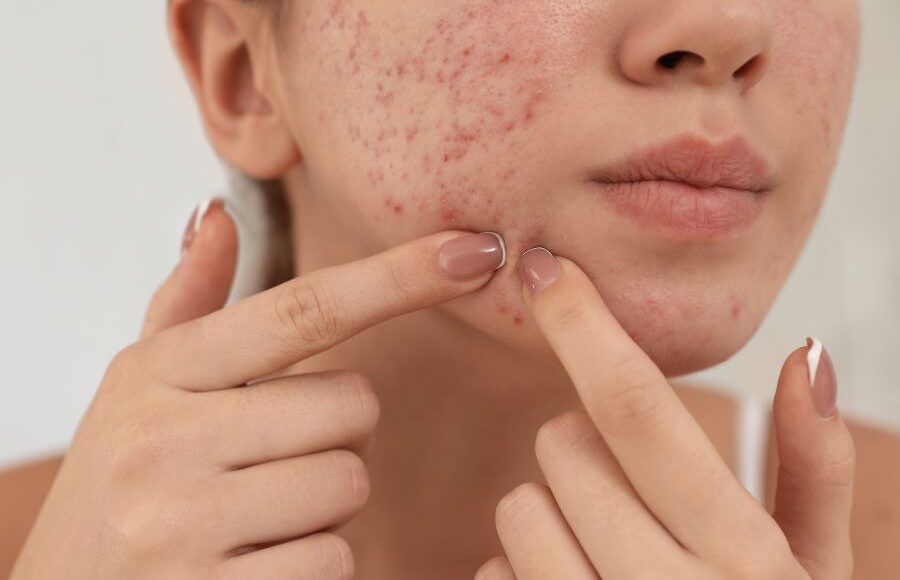 Breaking Out? Here's What Your Skin Is Trying to Tell You