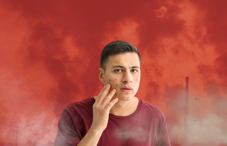 The Impact of Environmental Factors on Acne