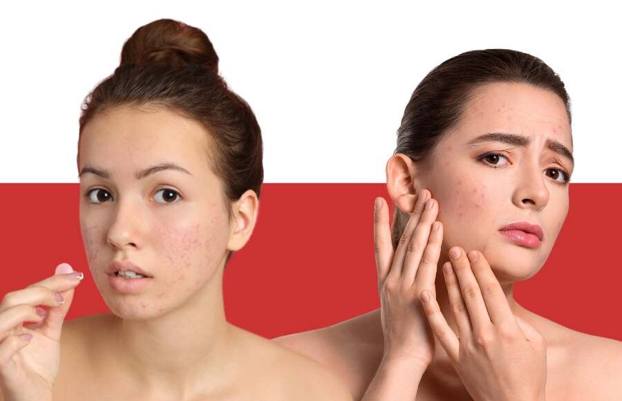 Acne in Different Life Stages: Managing Teenage Breakouts vs. Adult-Onset Acne