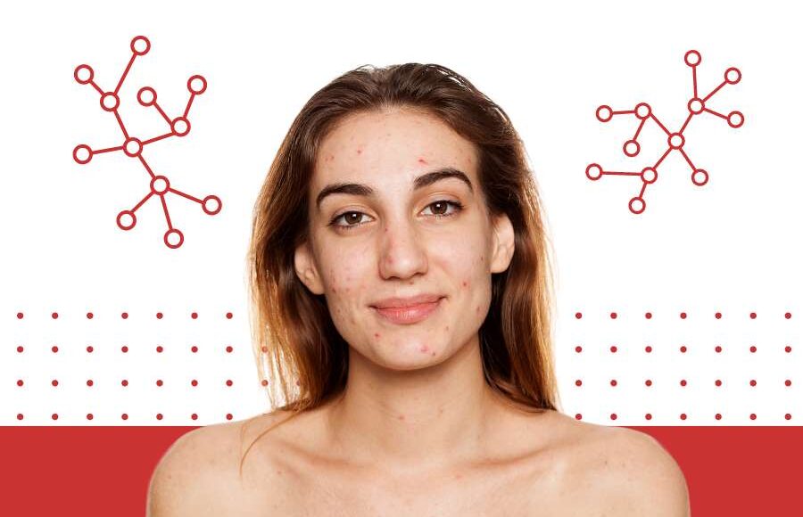 Hormonal Acne Treatment: Navigate Imbalance with Expert Tips