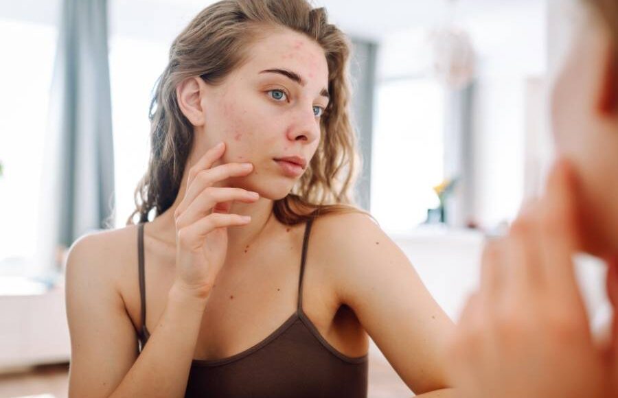 Acne Discrimination: Breaking Stigmas and Promoting Inclusivity in Beauty Standards