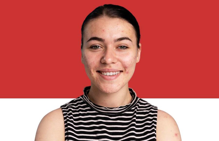 The Surprising Connection Between Acne and Delayed Aging