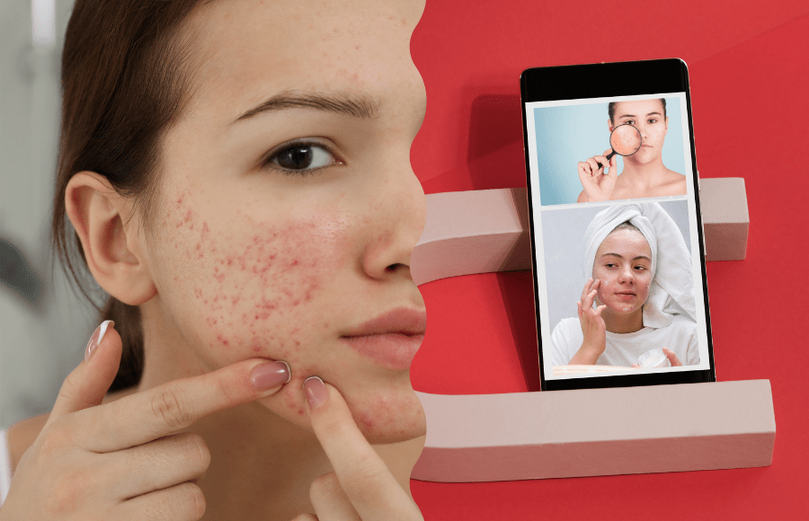 How Social Media Affects Acne Choices