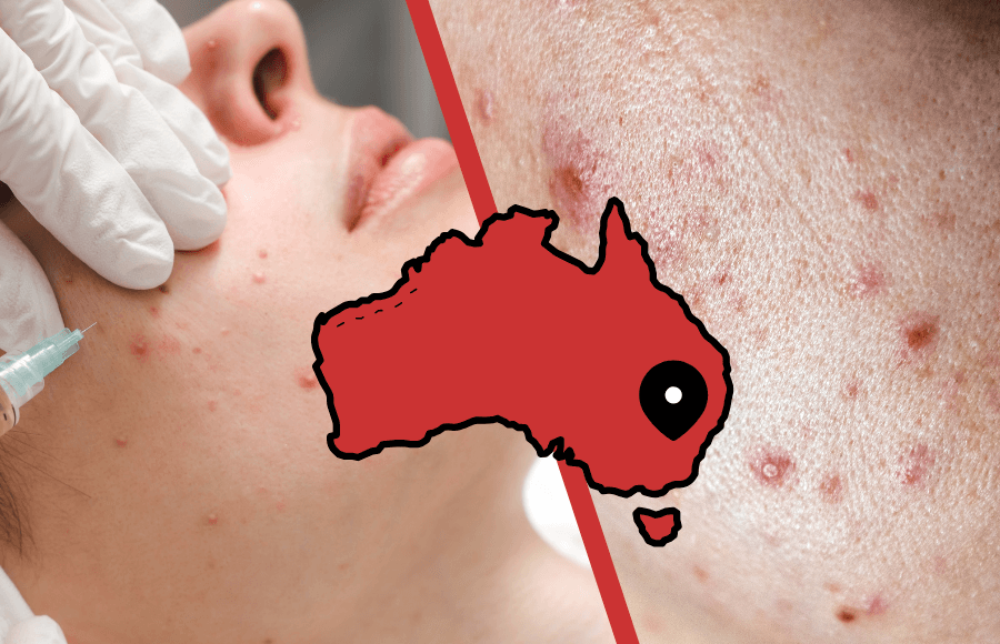 Cystic acne treatment in North Sydney