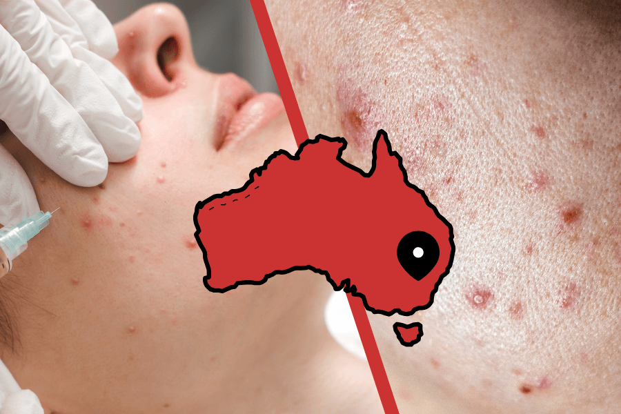 Cystic acne treatment in North Sydney