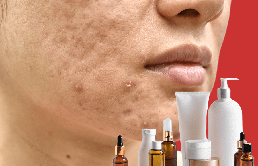 Pimple scars on face: Complete guide to types, causes & best removal options