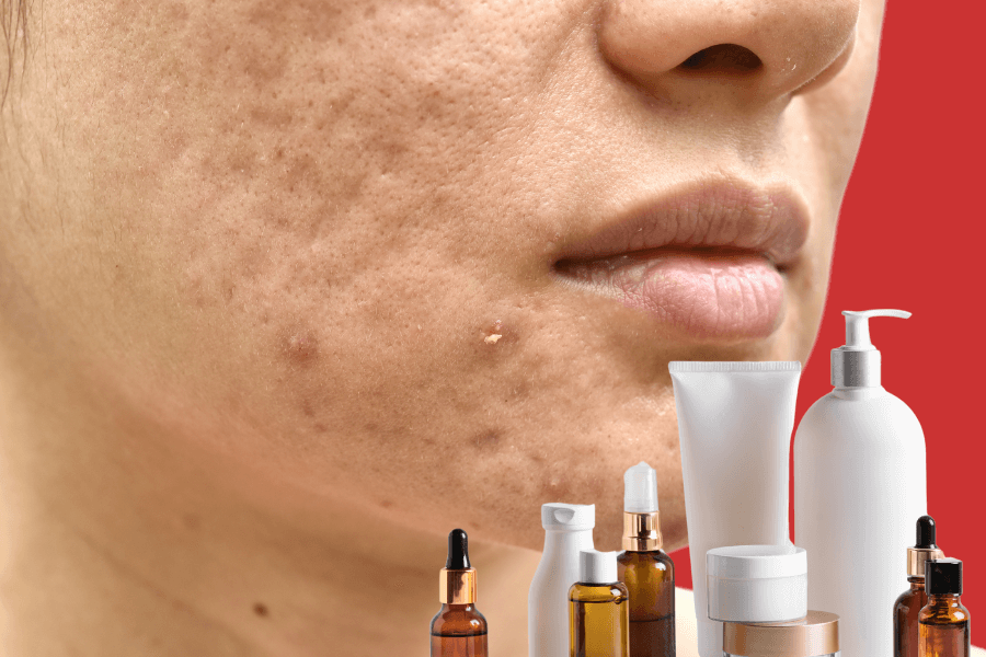 Pimple scars on face: Complete guide to types, causes & best removal options