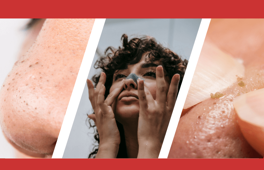 Blackheads Extraction: Safe Methods and Professional Tips 2025