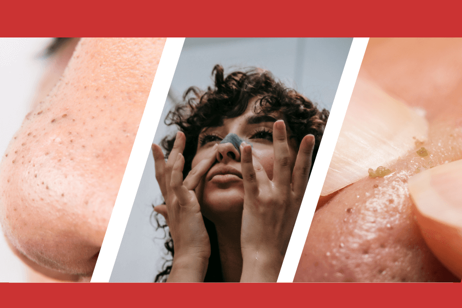 Blackheads Extraction: Safe Methods and Professional Tips 2025
