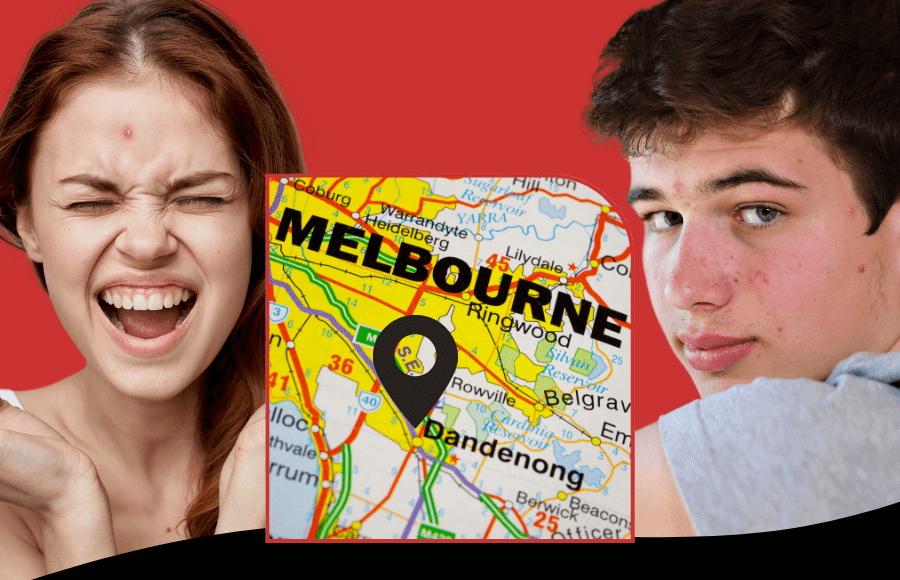 Finding the best teenage acne clinics in Dandenong, Melbourne: Your complete guide to clear skin