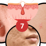 How to get rid of whiteheads fast: 7 proven methods that work
