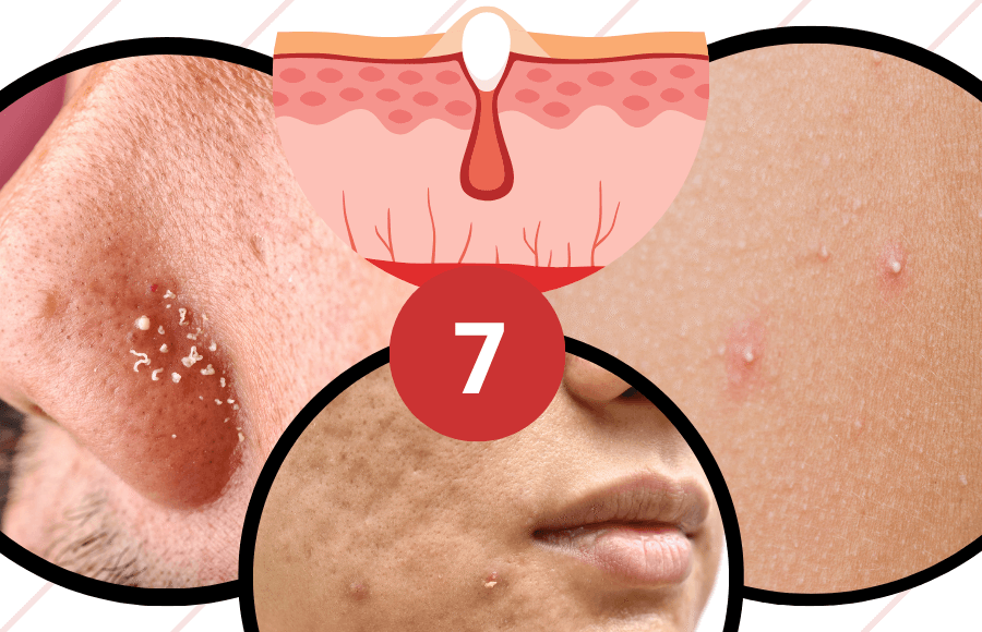 How to get rid of whiteheads fast: 7 proven methods that work
