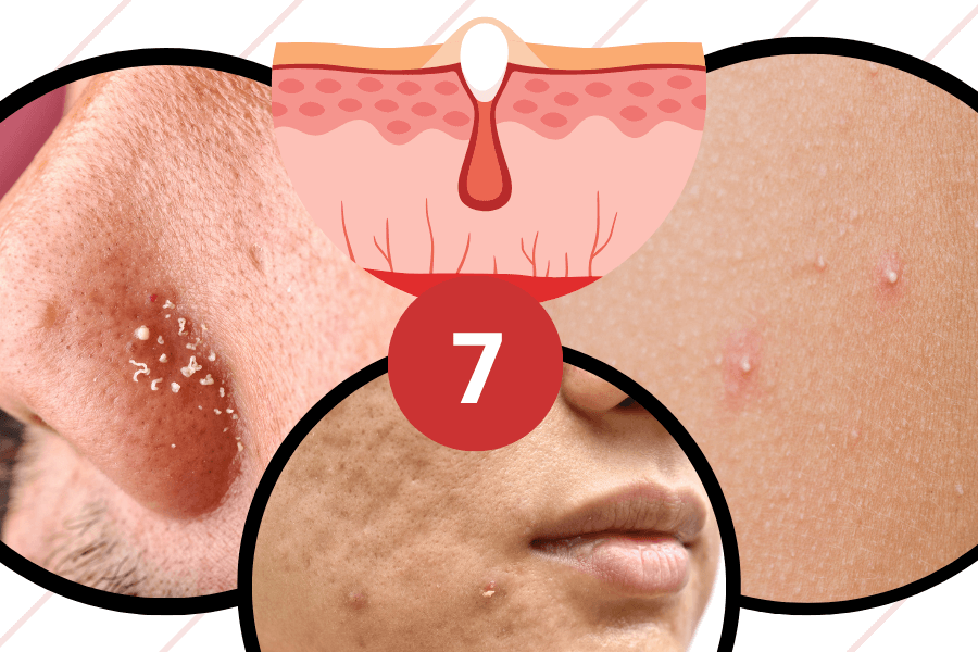 How to get rid of whiteheads fast: 7 proven methods that work