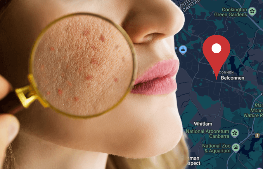 Best acne treatment in Belconnen: Clear skin solutions that work