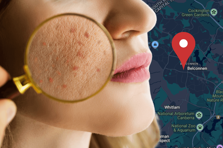 Best acne treatment in Belconnen: Clear skin solutions that work