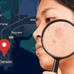 Professional acne treatment in Darwin - Dermatologist-approved methods