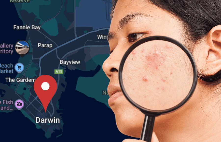 Professional acne treatment in Darwin - Dermatologist-approved methods