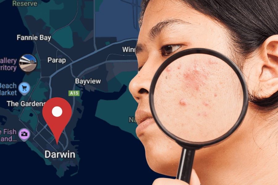 Professional acne treatment in Darwin - Dermatologist-approved methods