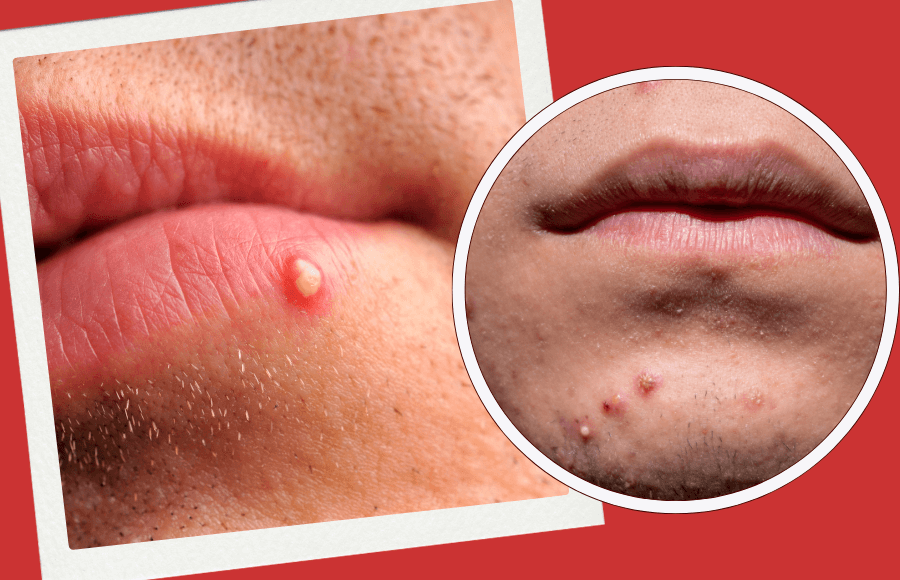 White pimples on lip: causes, treatment, and prevention guide