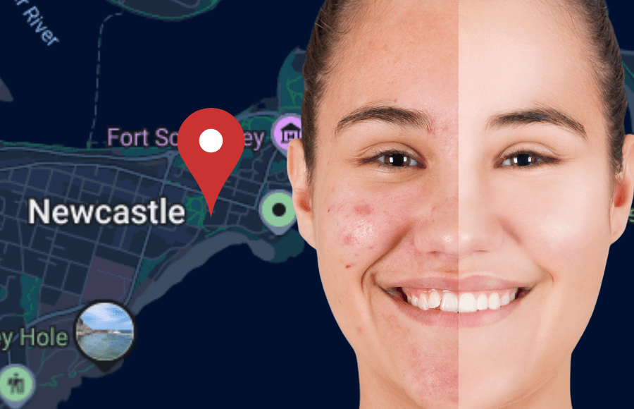 Best Acne Solutions in Newcastle: Clear Skin Treatments & Expert Care