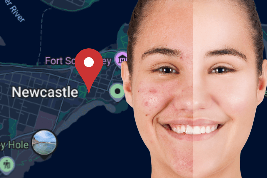 Best Acne Solutions in Newcastle: Clear Skin Treatments & Expert Care