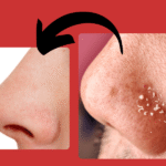 How to Get Rid of Whiteheads Fast