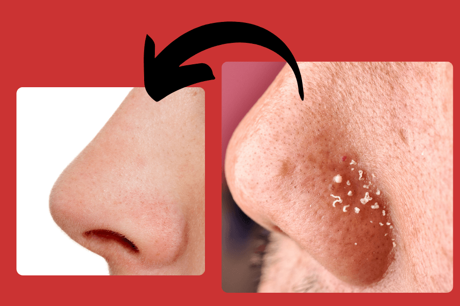 How to Get Rid of Whiteheads Fast