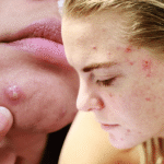 Types of pimples: Complete guide to identifying different acne breakouts