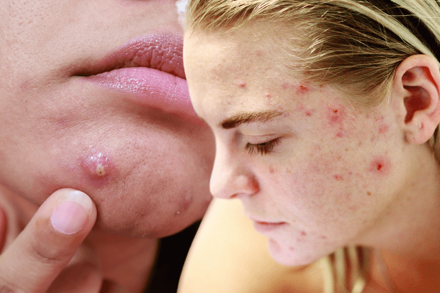 Types of pimples: Complete guide to identifying different acne breakouts