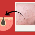Black pimples on face - What they are and how to deal with them