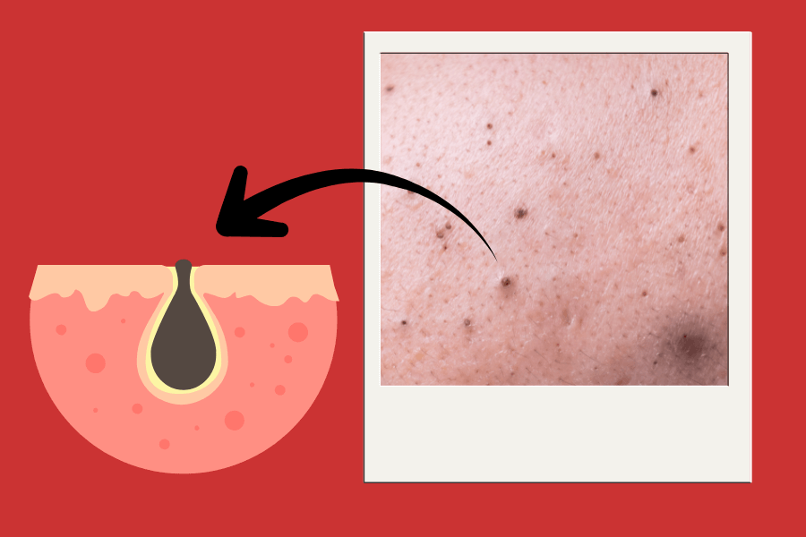 Black pimples on face - What they are and how to deal with them
