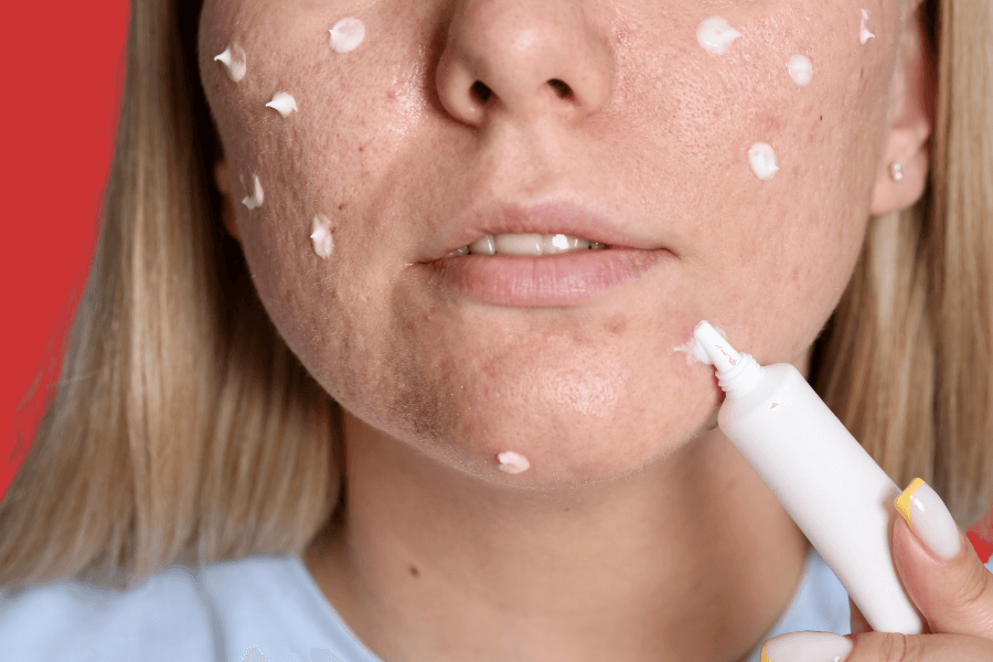 Complete guide to pimple scar treatment: Medical options, home remedies, and expected outcomes 