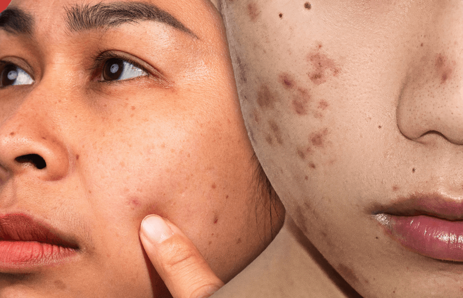 Effective ways to get rid of spots and dark marks: a complete guide