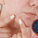 Pimple treatments in Southport (Brisbane) Pimple treatments in Southport (Brisbane)