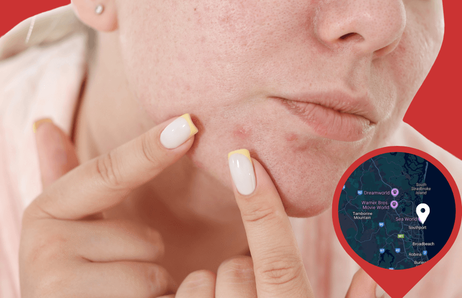 Pimple treatments in Southport (Brisbane)
