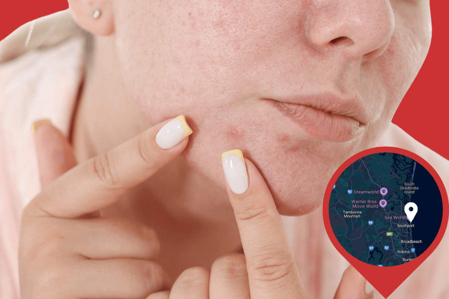 Pimple treatments in Southport (Brisbane) Pimple treatments in Southport (Brisbane)