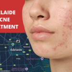 Adelaide Acne Treatment: Getting Your Skin Back on Track