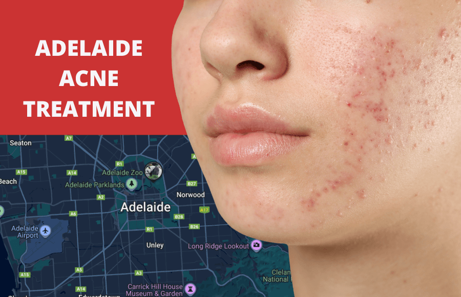 Adelaide Acne Treatment: Getting Your Skin Back on Track