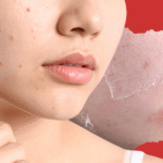 Dry Skin Pimples: Surprising Causes And How To Treat Them Naturally
