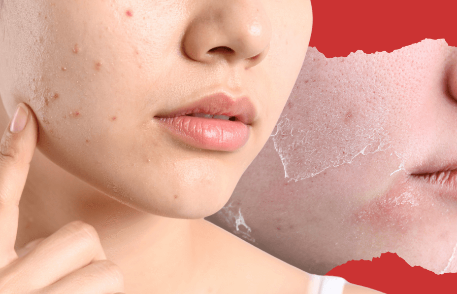 Dry Skin Pimples: Surprising Causes And How To Treat Them Naturally
