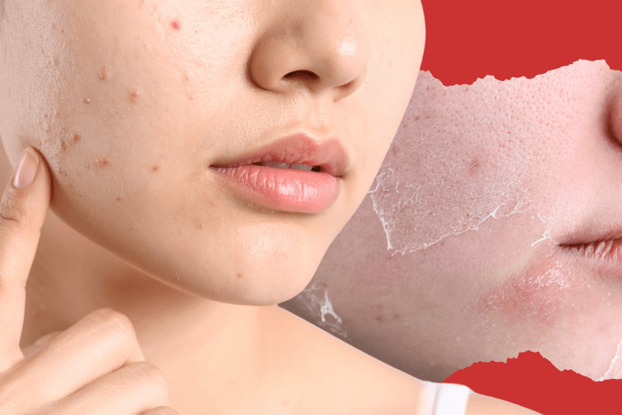 Dry Skin Pimples: Surprising Causes And How To Treat Them Naturally