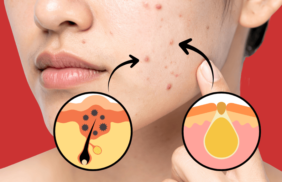 The Causes of Acne: Why Your Face Hates You Right Now