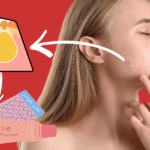 Pimple treatment: Causes, types, and dermatologist-approved solutions