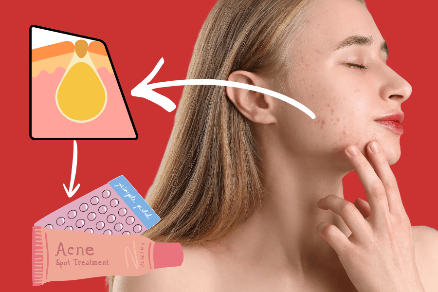 Pimple treatment: Causes, types, and dermatologist-approved solutions