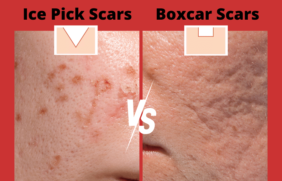 Ice Pick Scars vs Boxcar Scars: Key Differences, Causes, and Treatment Options