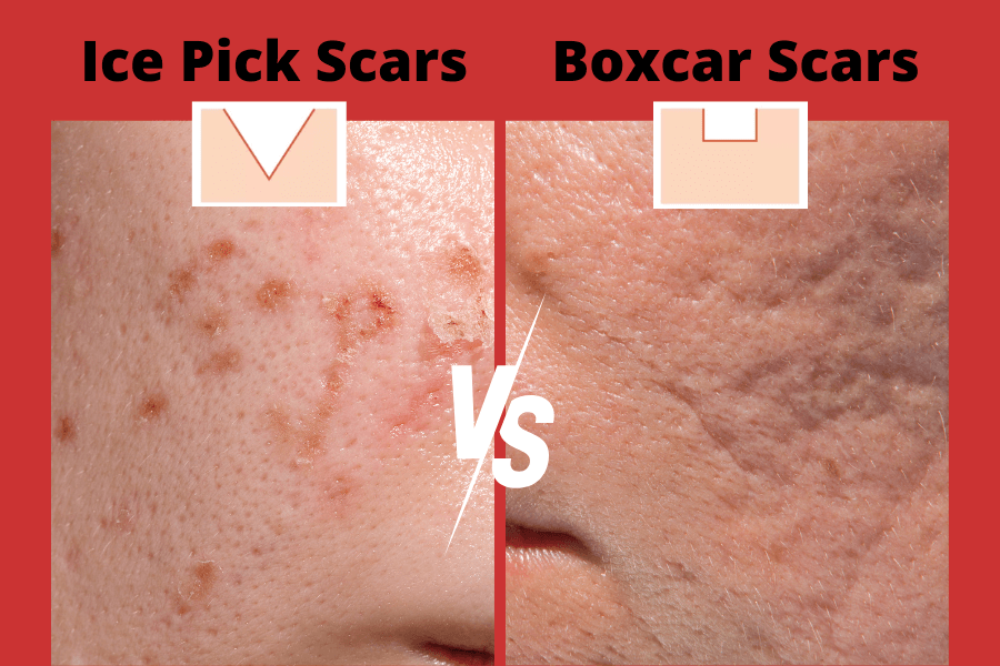 Ice Pick Scars vs Boxcar Scars: Key Differences, Causes, and Treatment Options