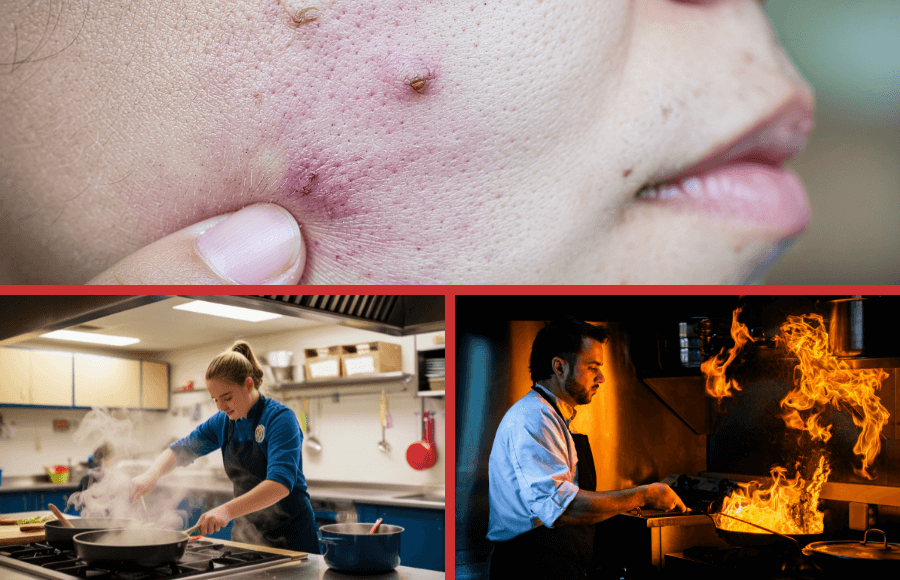 Kitchen Acne: Can Cooking Habits Contribute to Facial Breakouts?