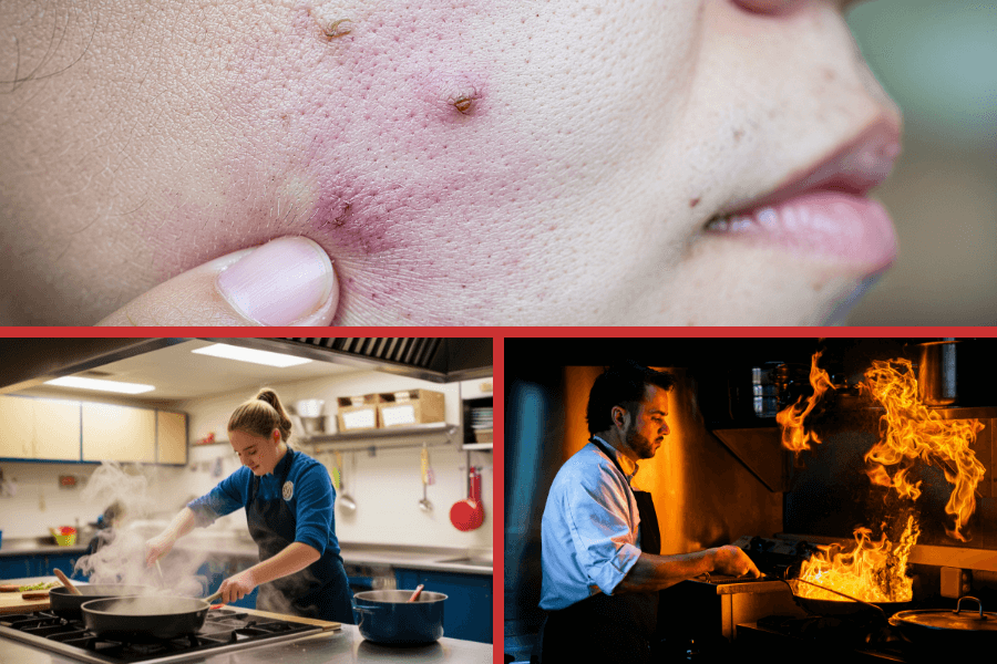 Kitchen Acne: Can Cooking Habits Contribute to Facial Breakouts?