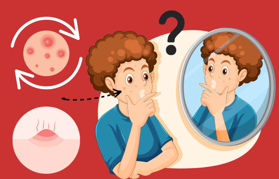 Recurring Acne: 5 Reasons You Have Pimples in the Same Spot